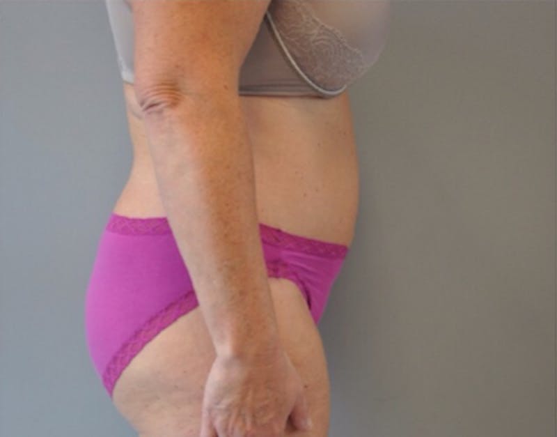 Plus Size Tummy Tuck Before & After Gallery - Patient 373437 - Image 6