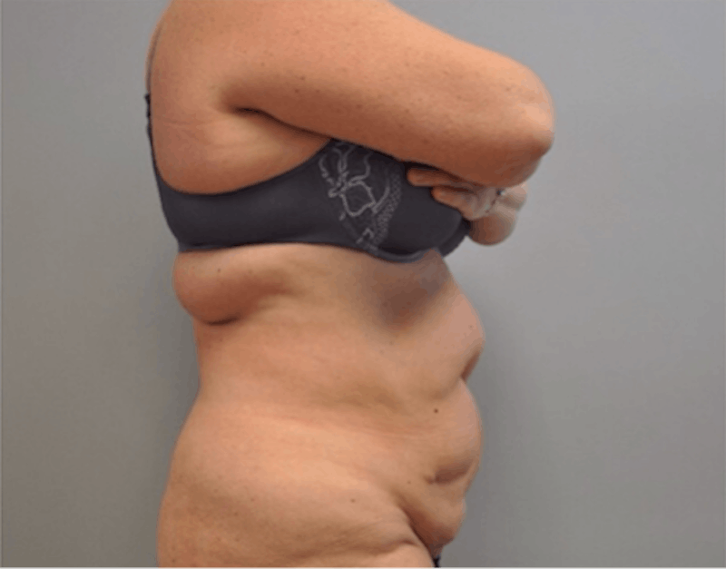 Extended Tummy Tuck Before & After Gallery - Patient 373437 - Image 5