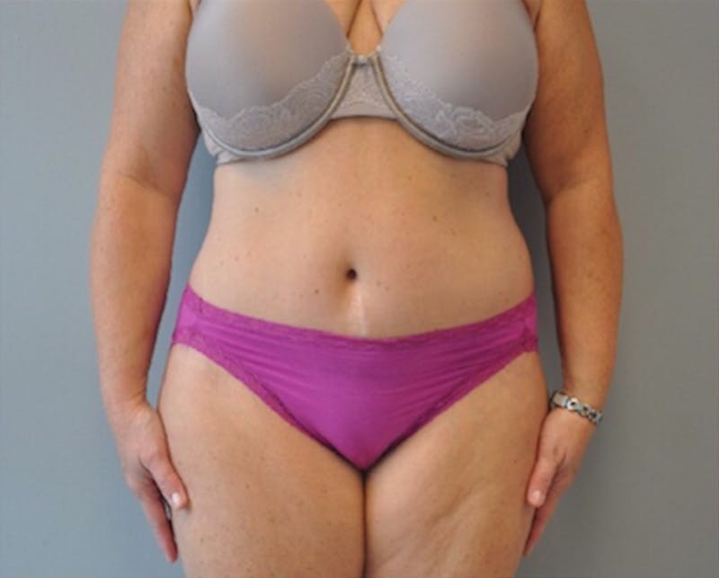 Extended Tummy Tuck Before & After Gallery - Patient 373437 - Image 2
