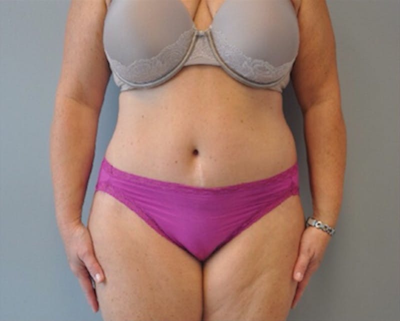 Plus Size Tummy Tuck Before & After Gallery - Patient 373437 - Image 2