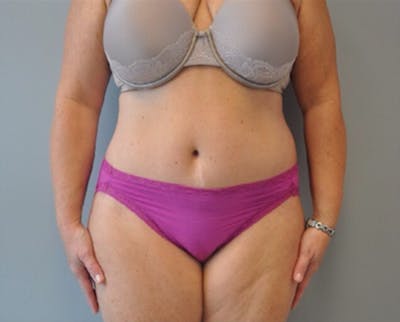 Plus Size Tummy Tuck Before & After Gallery - Patient 373437 - Image 2