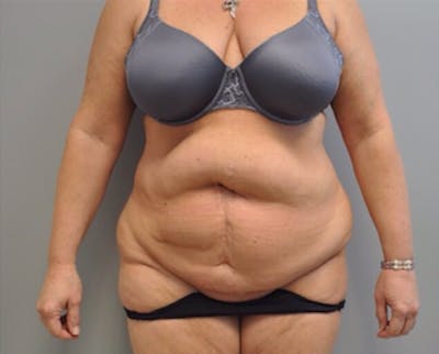Tummy Tuck Before & After Gallery - Patient 55345324 - Image 1