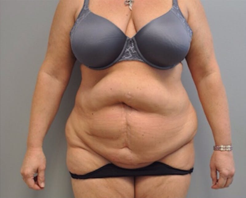 Plus Size Tummy Tuck Before & After Gallery - Patient 373437 - Image 1