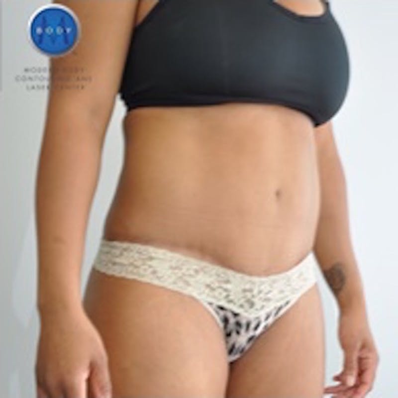 Tummy Tuck Before & After Gallery - Patient 55345315 - Image 6
