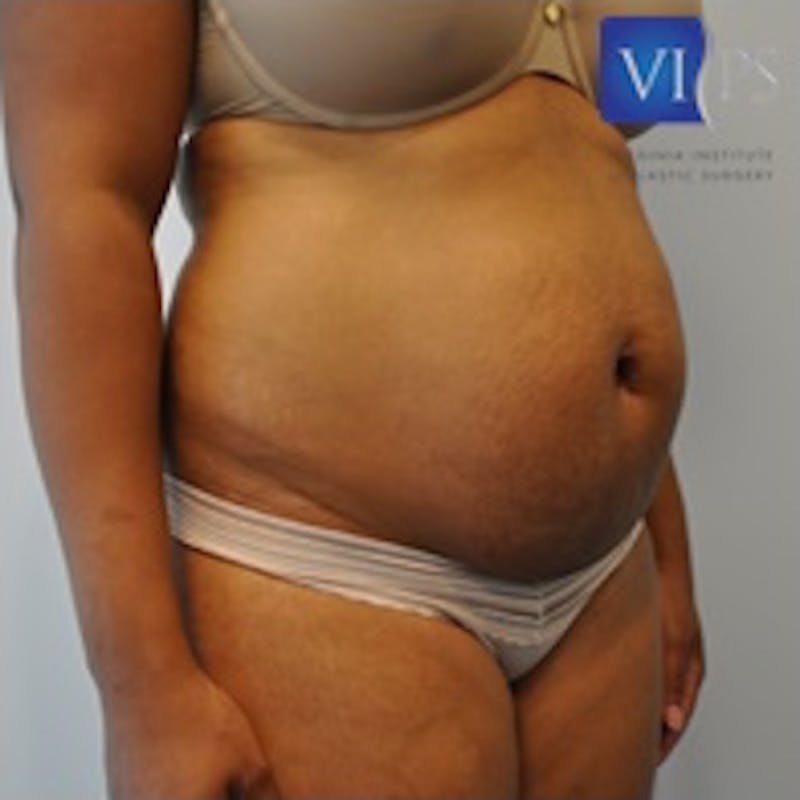 Tummy Tuck Before & After Gallery - Patient 55345315 - Image 5