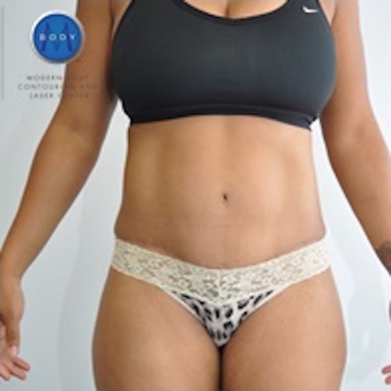 Tummy Tuck Before & After Gallery - Patient 55345315 - Image 2