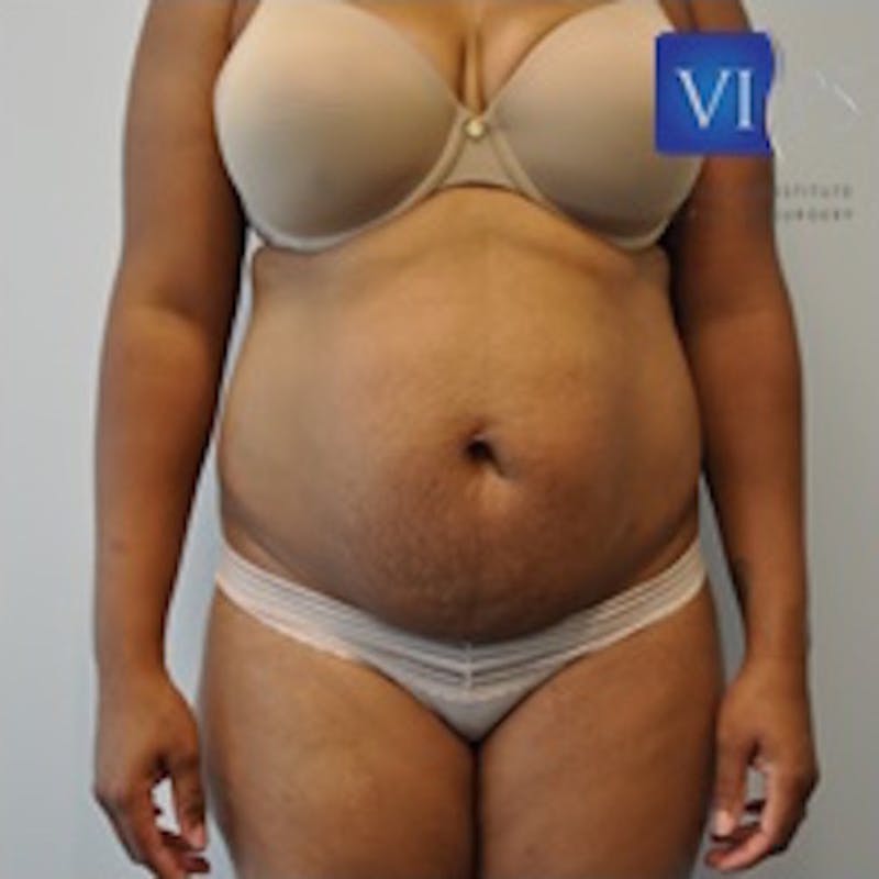 Tummy Tuck Before & After Gallery - Patient 55345315 - Image 1