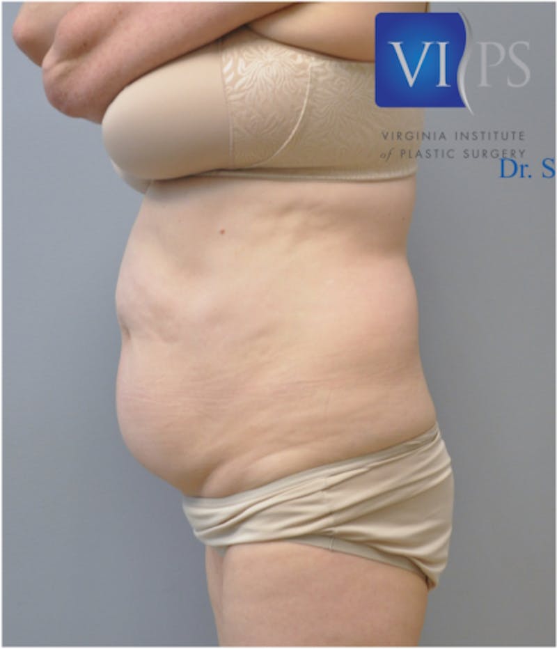 Liposuction Before & After Gallery - Patient 211876608 - Image 3