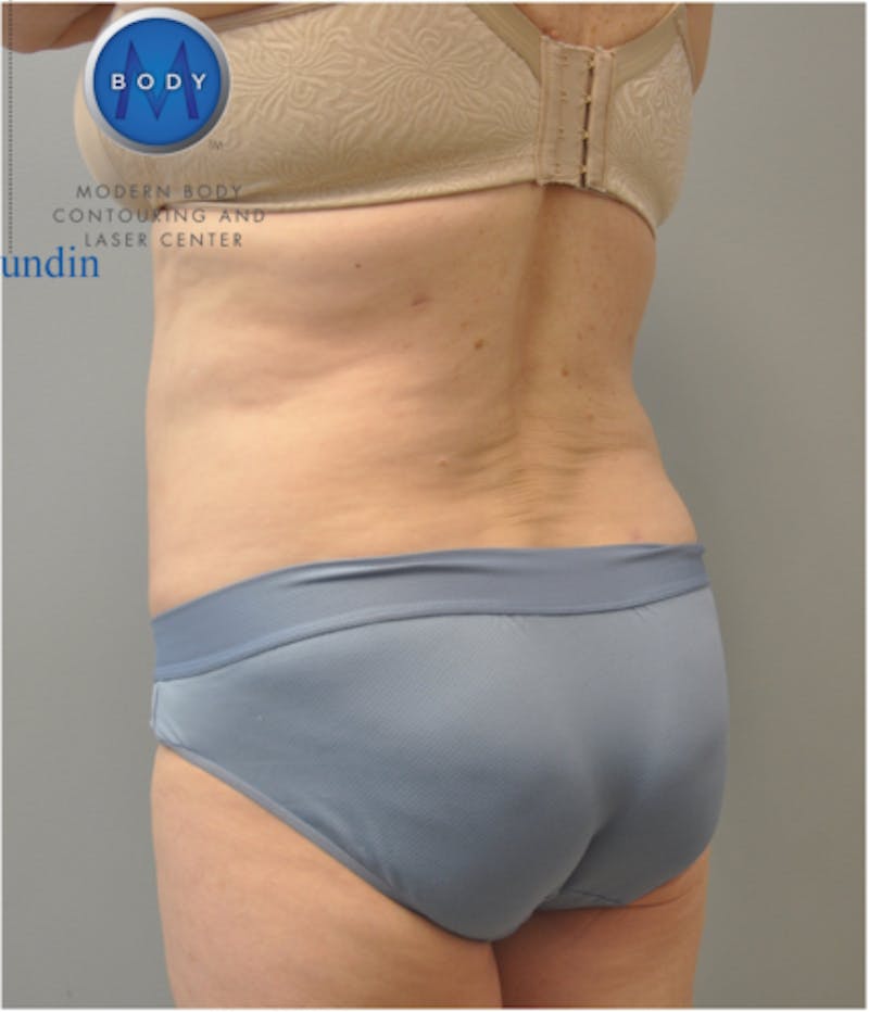 Renuvion J-Plasma Before & After Gallery - Patient 211876567 - Image 6