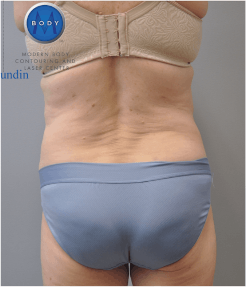 Liposuction Before & After Gallery - Patient 211876608 - Image 2