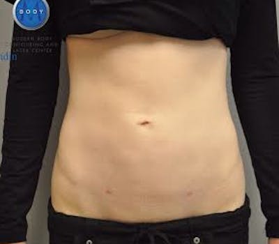Liposuction Before & After Gallery - Patient 211876584 - Image 2