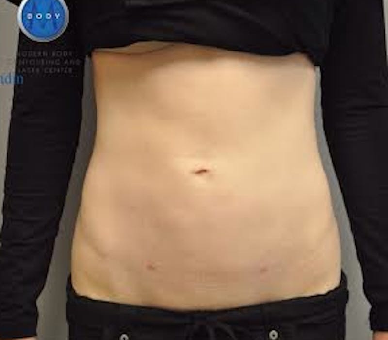 Liposuction Before & After Gallery - Patient 211876584 - Image 2