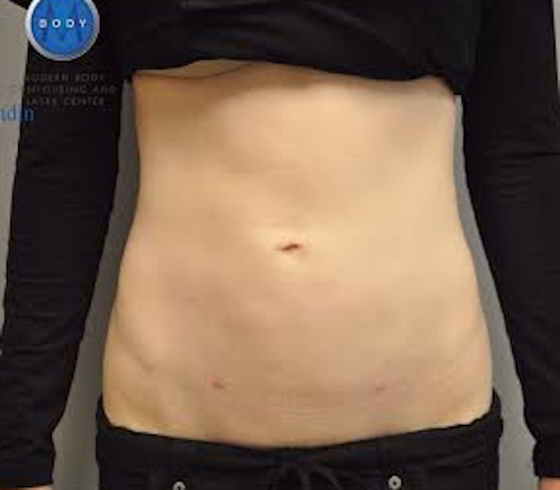 Renuvion J-Plasma Before & After Gallery - Patient 55423257 - Image 2