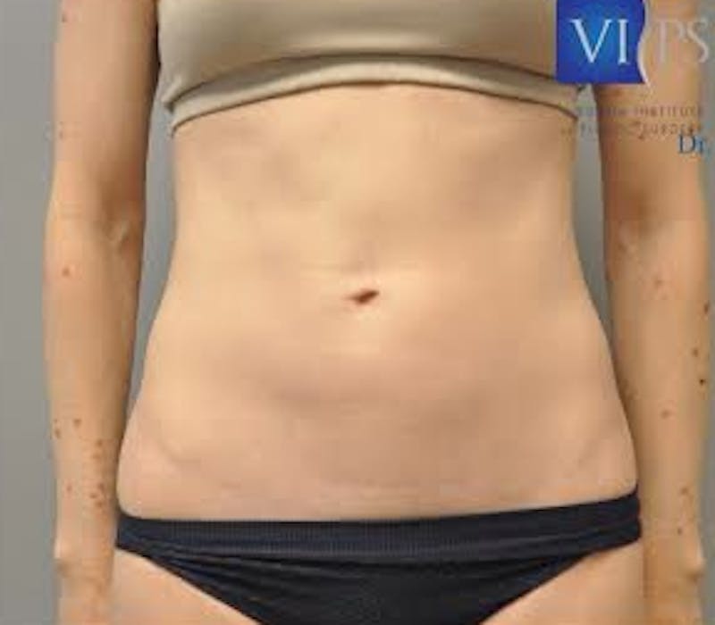 Renuvion J-Plasma Before & After Gallery - Patient 211876565 - Image 1