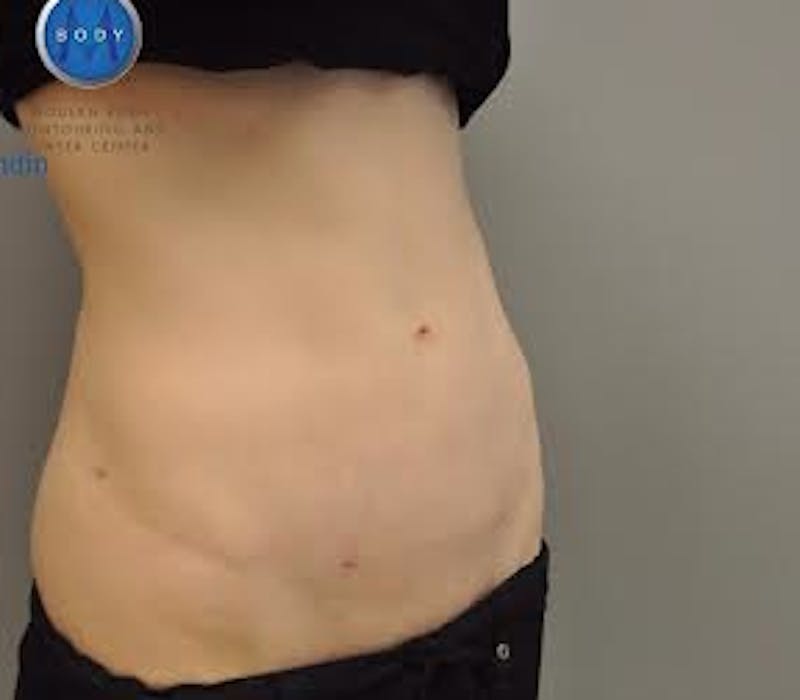 Renuvion J-Plasma Before & After Gallery - Patient 211876565 - Image 4
