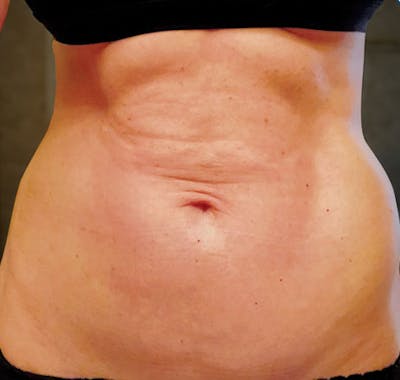 Liposuction Before & After Gallery - Patient 211876586 - Image 1