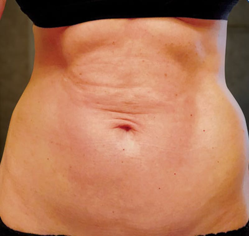 Liposuction Before & After Gallery - Patient 211876586 - Image 1
