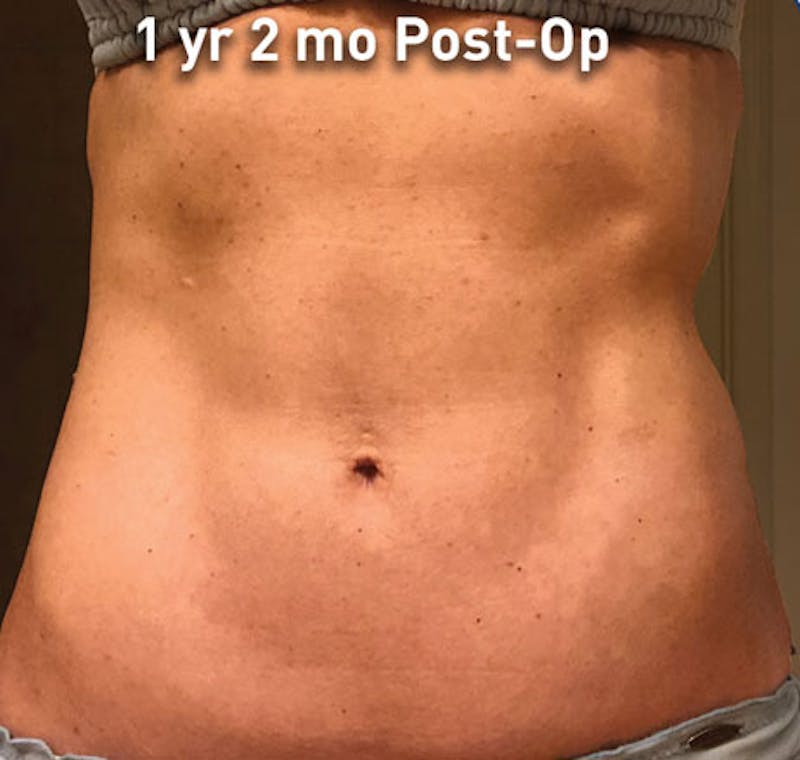 Liposuction Before & After Gallery - Patient 211876586 - Image 2