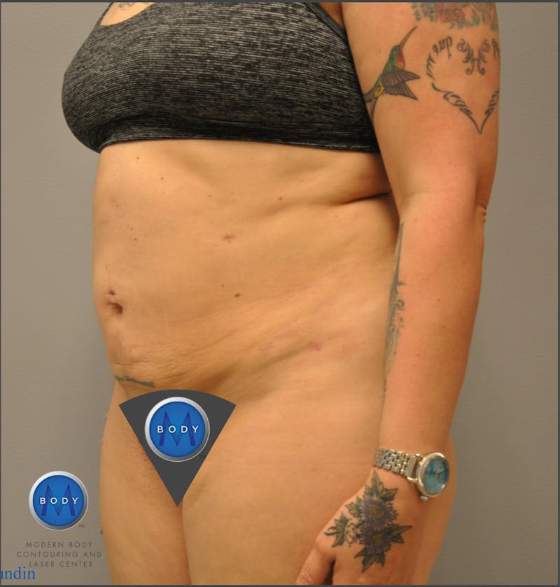 Renuvion J-Plasma Before & After Gallery - Patient 55423267 - Image 4