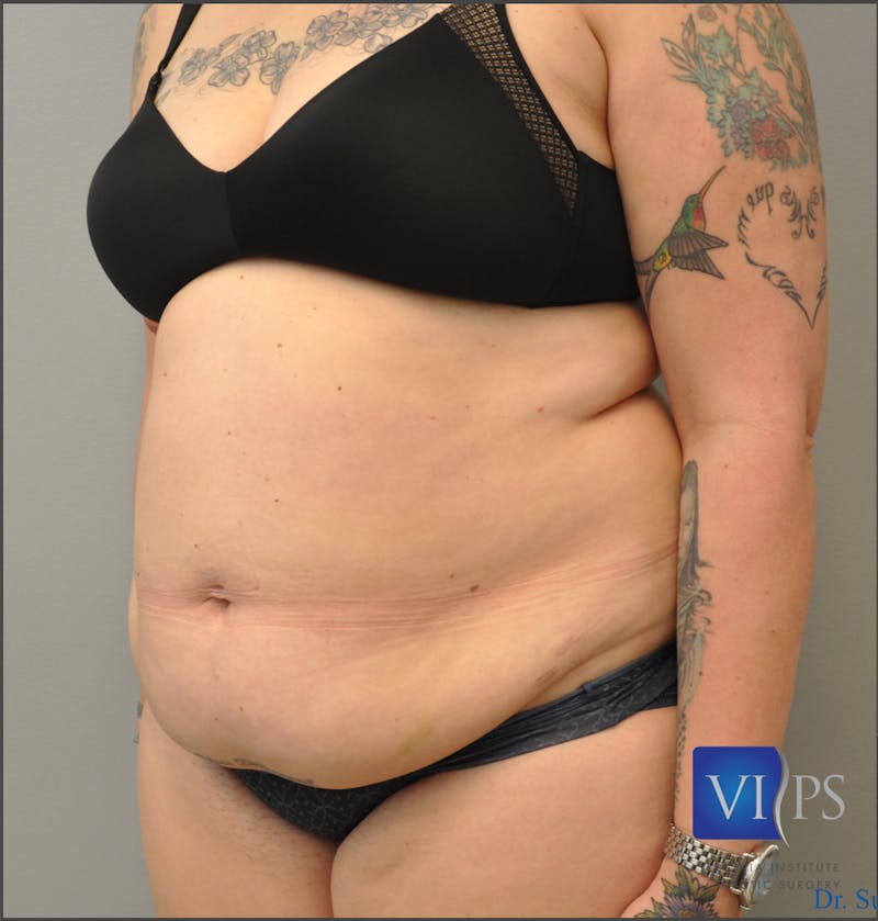 Renuvion J-Plasma Before & After Gallery - Patient 55423267 - Image 3