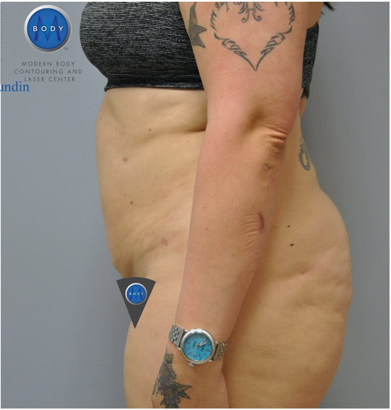 Renuvion J-Plasma Before & After Gallery - Patient 55423267 - Image 6