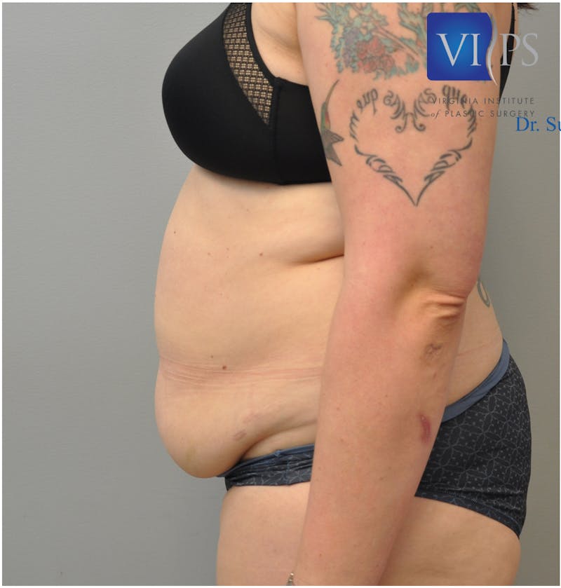 Renuvion J-Plasma Before & After Gallery - Patient 55423267 - Image 5