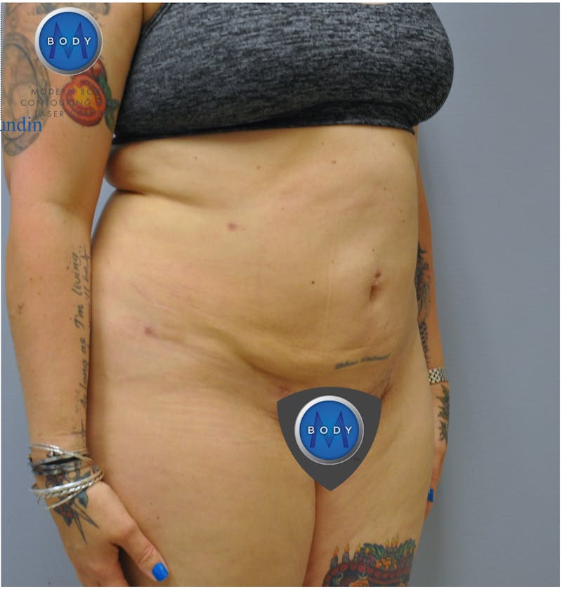 Renuvion J-Plasma Before & After Gallery - Patient 55423267 - Image 8
