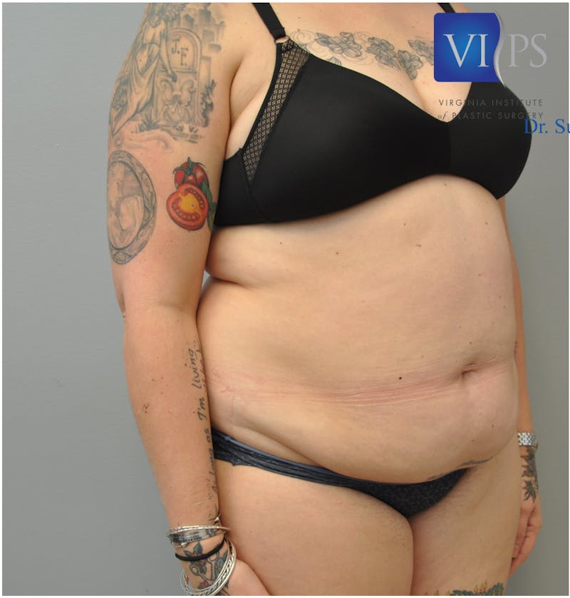 Renuvion J-Plasma Before & After Gallery - Patient 55423267 - Image 7