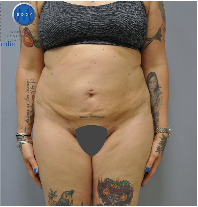 Renuvion J-Plasma Before & After Gallery - Patient 55423267 - Image 2