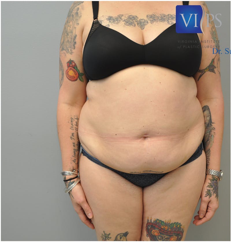 Renuvion J-Plasma Before & After Gallery - Patient 55423267 - Image 1