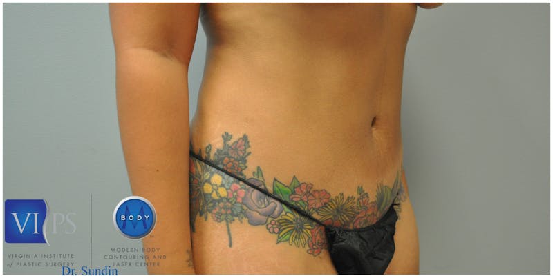 Renuvion J-Plasma Before & After Gallery - Patient 55423285 - Image 1