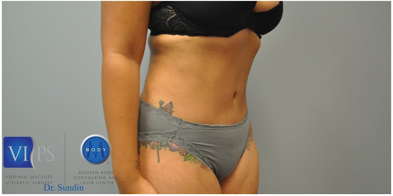 Renuvion J-Plasma Before & After Gallery - Patient 55423285 - Image 2