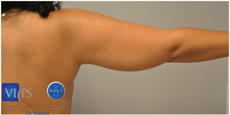 Renuvion J-Plasma Before & After Gallery - Patient 55423285 - Image 3