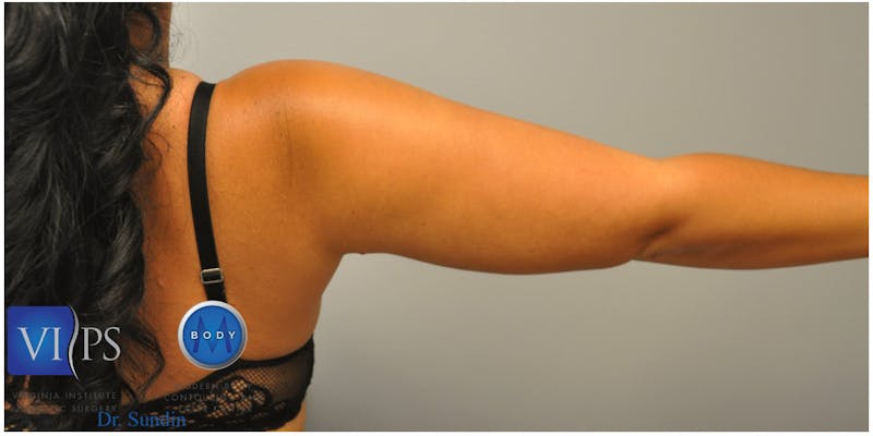 Renuvion J-Plasma Before & After Gallery - Patient 55423285 - Image 4