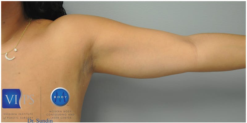 Renuvion J-Plasma Before & After Gallery - Patient 55423285 - Image 5