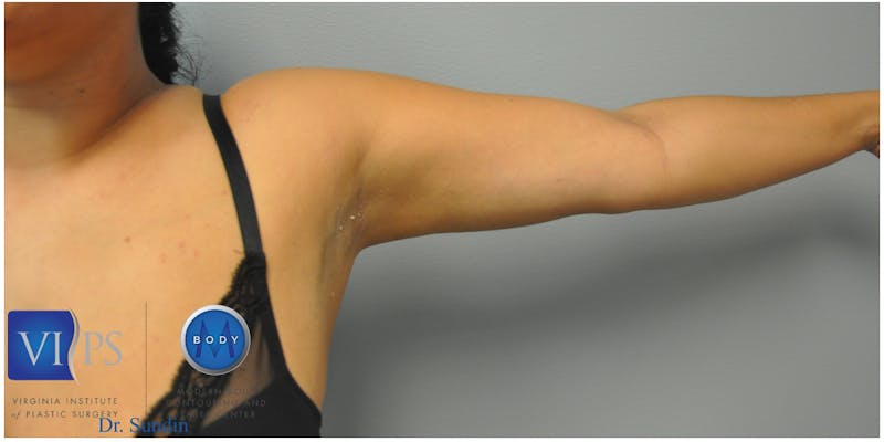 Renuvion J-Plasma Before & After Gallery - Patient 55423285 - Image 6