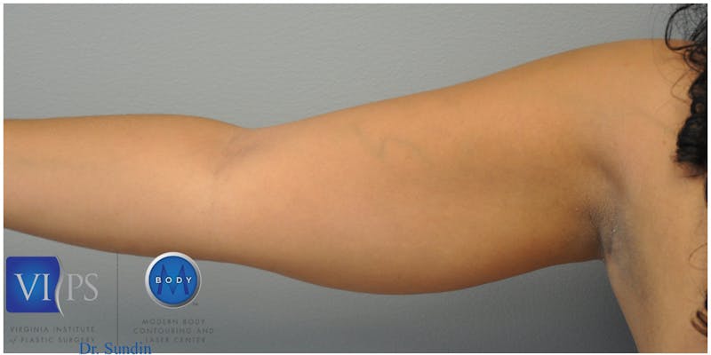 Renuvion J-Plasma Before & After Gallery - Patient 55423285 - Image 7