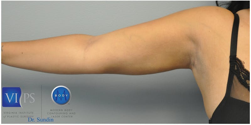 Renuvion J-Plasma Before & After Gallery - Patient 55423285 - Image 8