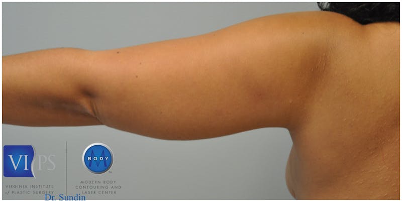 Renuvion J-Plasma Before & After Gallery - Patient 55423285 - Image 9