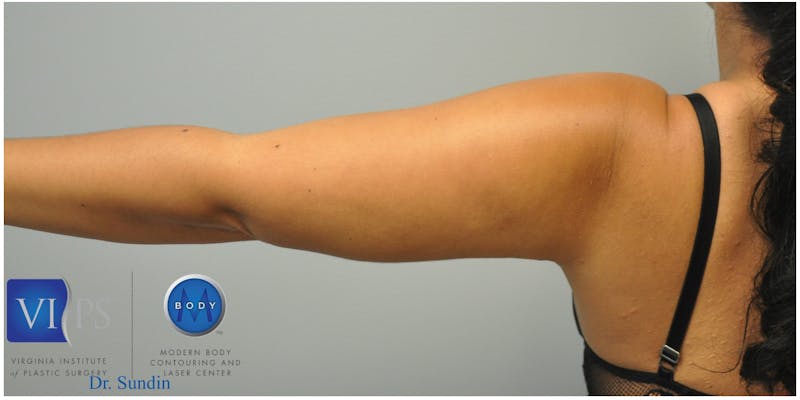 Renuvion J-Plasma Before & After Gallery - Patient 55423285 - Image 10