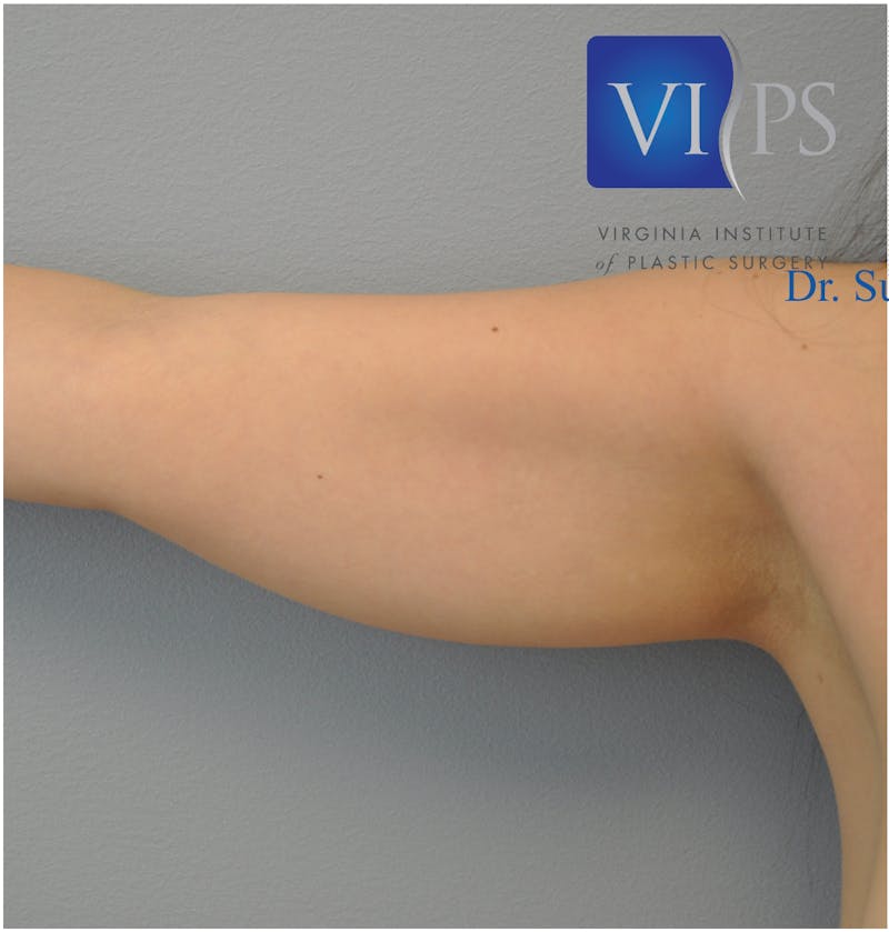 Renuvion J-Plasma Before & After Gallery - Patient 55423303 - Image 1