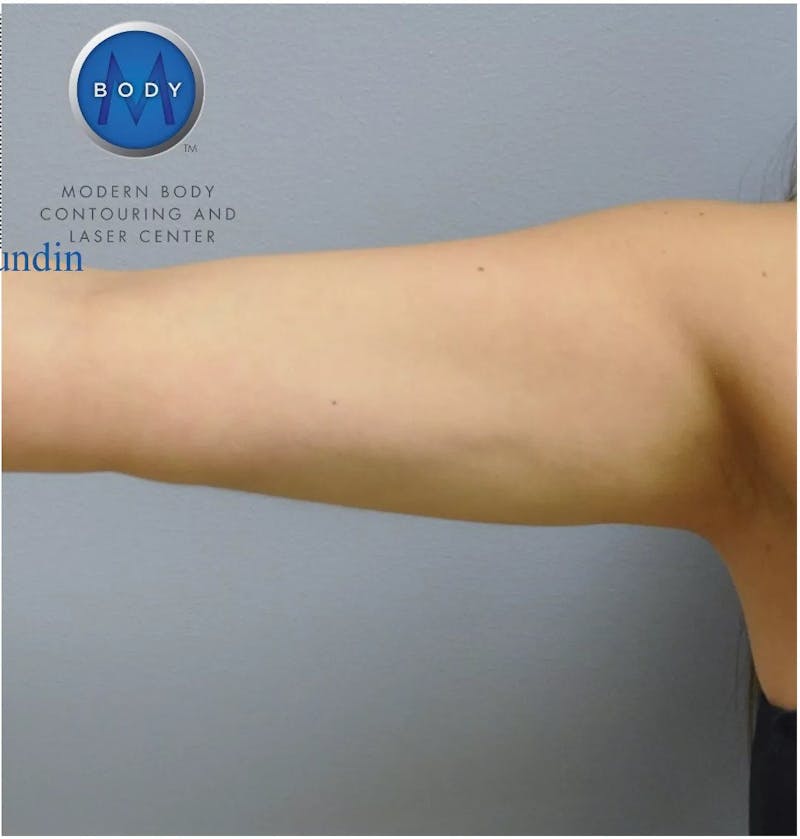 Renuvion J-Plasma Before & After Gallery - Patient 55423303 - Image 2