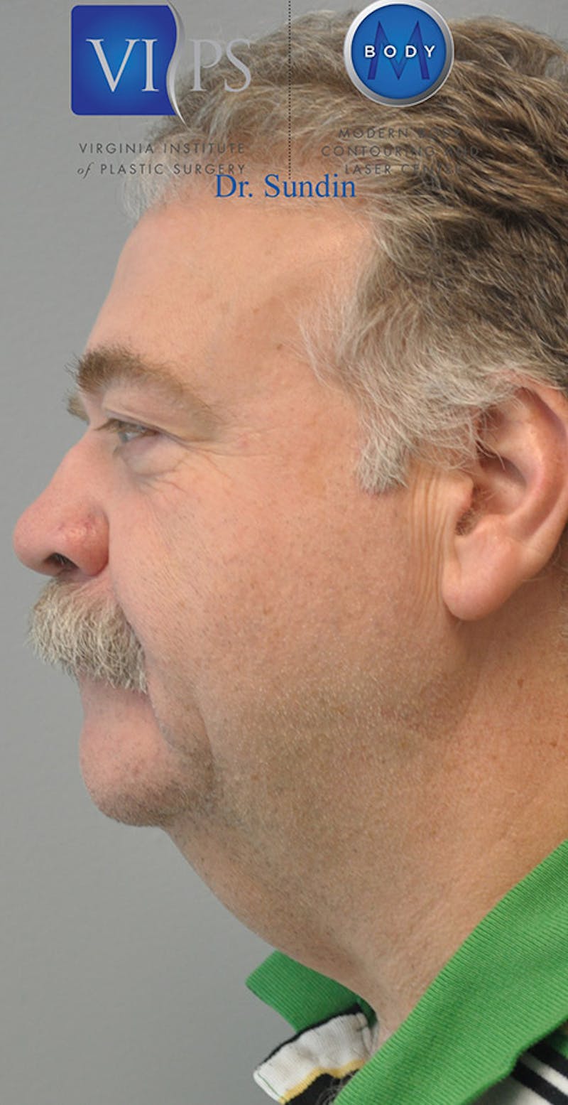 Renuvion J-Plasma Before & After Gallery - Patient 55423304 - Image 3