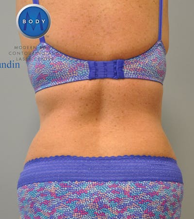 Liposuction Before & After Gallery - Patient 211876607 - Image 2