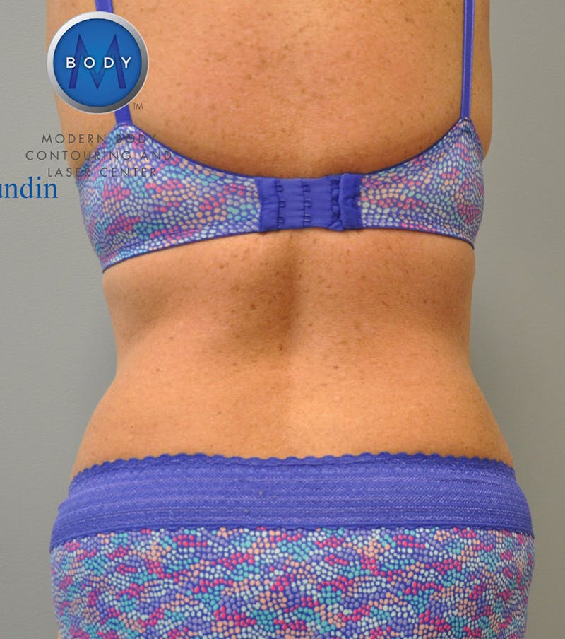 Renuvion J-Plasma Before & After Gallery - Patient 55423321 - Image 2