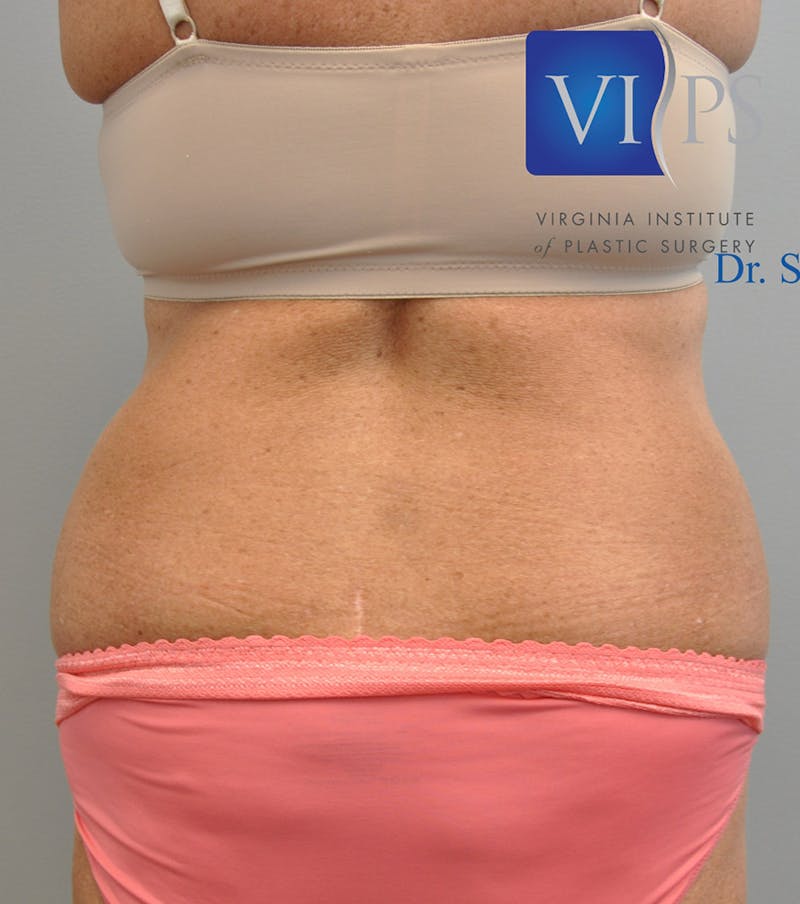 Renuvion J-Plasma Before & After Gallery - Patient 211876561 - Image 1