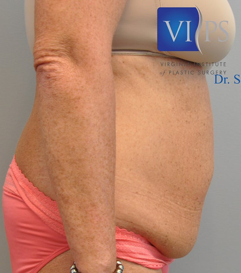 Renuvion J-Plasma Before & After Gallery - Patient 211876561 - Image 3
