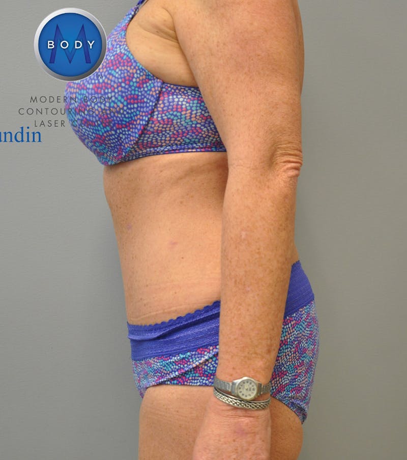 Liposuction Before & After Gallery - Patient 211876607 - Image 6