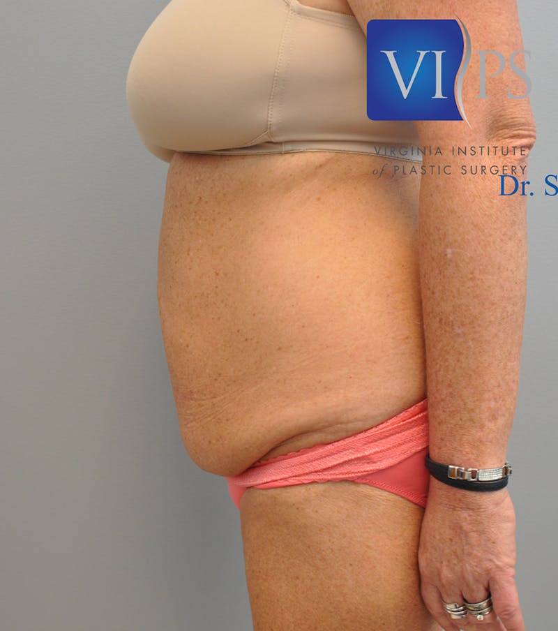 Liposuction Before & After Gallery - Patient 211876607 - Image 5