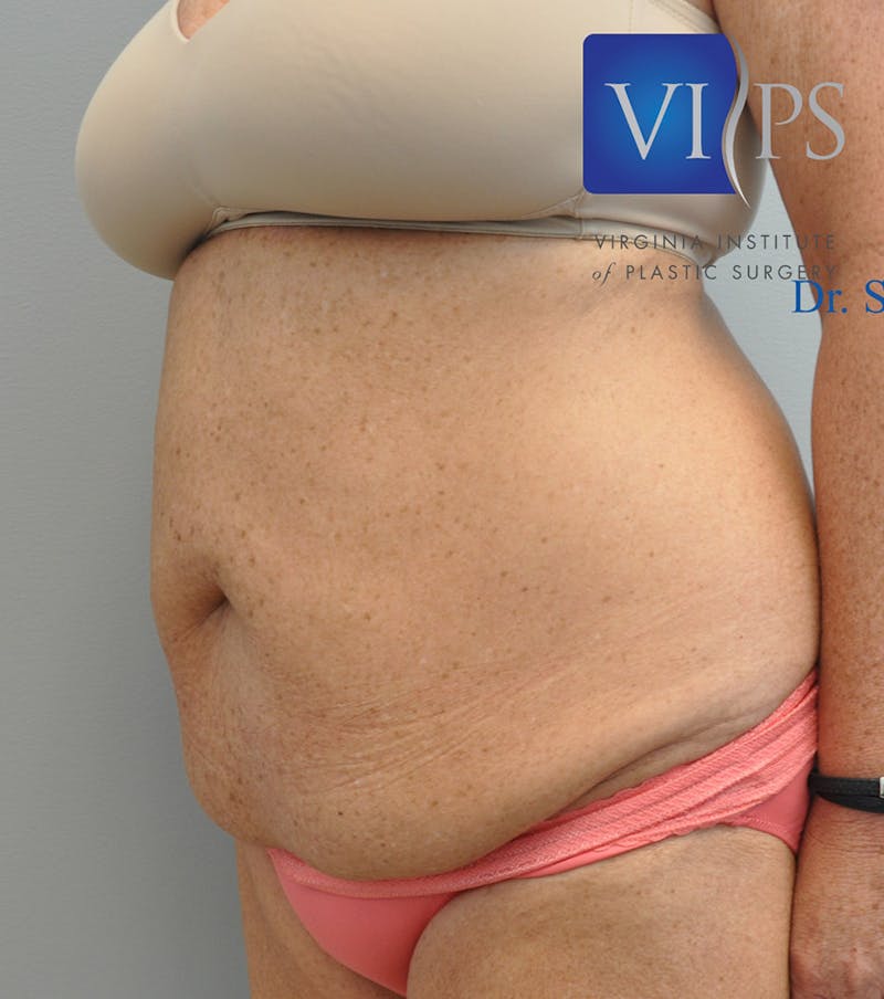 Renuvion J-Plasma Before & After Gallery - Patient 211876561 - Image 7